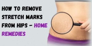 Read more about the article How to Remove Stretch Marks from hips